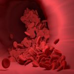 Penyebab Pembuluh Darah Bisa Pecah: Kenali Faktor yang Membahayakan